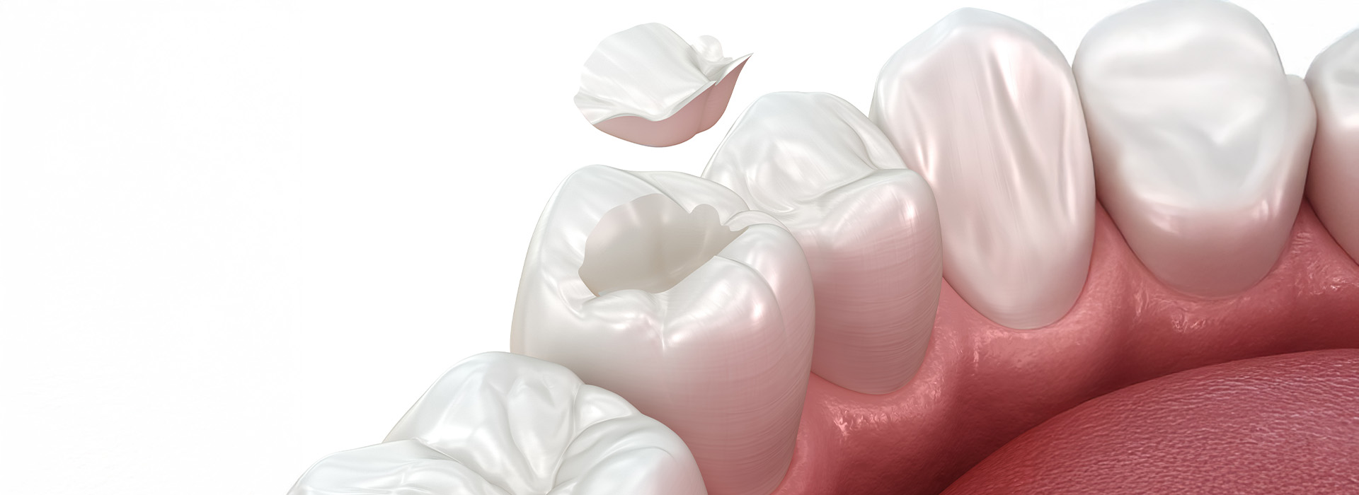 Smiles Elevated | Deep Cleaning, Oral Cancer Screening and iTero trade  NIRI Caries Detection