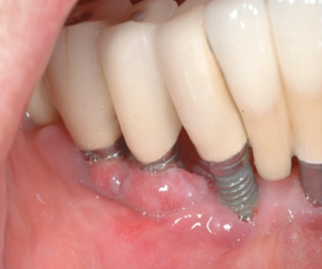 Smiles Elevated | Laser Gum Treatment, Full Mouth Reconstruction and Arestin reg