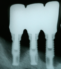 Smiles Elevated | Schick 33 Digital Radiography, Implant Restoration and Composite Fillings