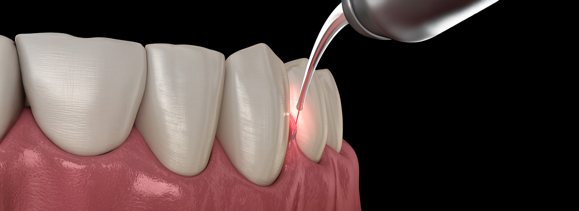 Smiles Elevated | Teeth Whitening, Scaling and Root Planing and Implant Restoration