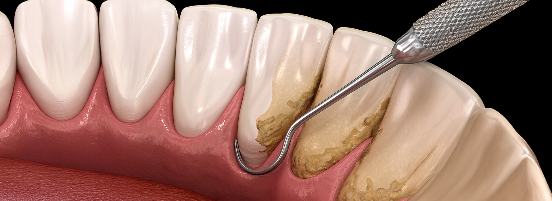 Smiles Elevated | Implant Supported Dentures, Ceramic Crowns and Traditional Dentures Full amp Partial