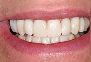 Smiles Elevated | Cosmetic Dentistry, Sleep Apnea Appliances and Invisalign reg 
