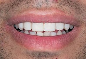 Smiles Elevated | Cosmetic Dentistry, Scaling and Root Planing and Teeth Whitening