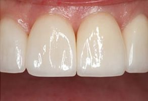 Smiles Elevated | Implants, Bad Breath and Impressionless Dentistry